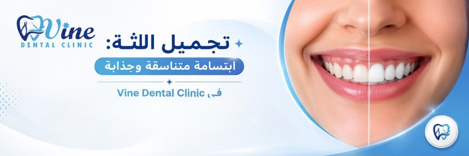 تجميل اللثة: ابتسامة متناسقة وجذابة في Vine Dental Clinic